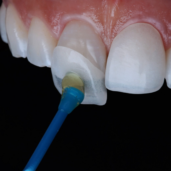 Corona tipo Veneer metallo-composito