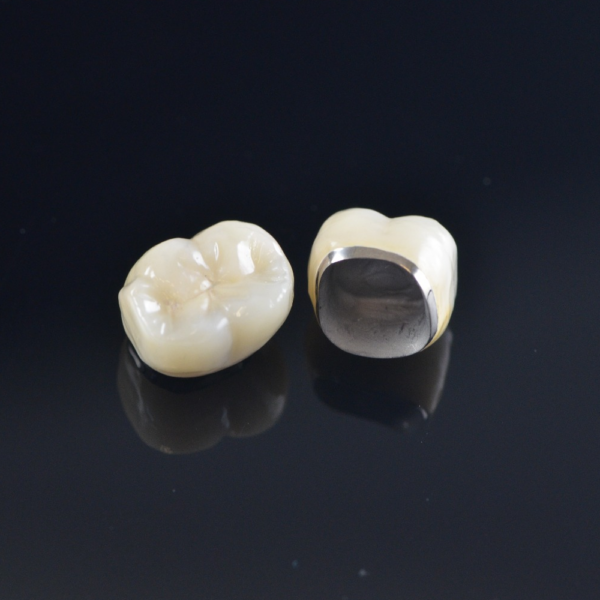 Corona metallo-ceramica